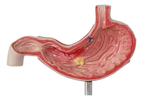 Modelo De Úlcera Gástrica Humana