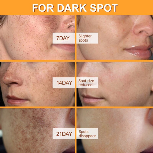 Crema Facial Para Eliminar Manchas, Pigmentos Oscuros, Para