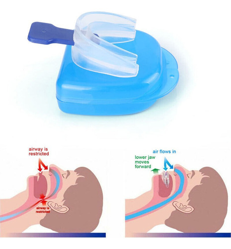 Protector Dental Doble Función | Bruxismo | Anti Ronquidos