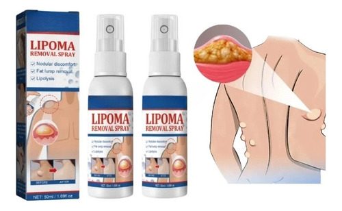 Productos Para El Cuidado De La Piel Lipoma Fatty Knot En Ae