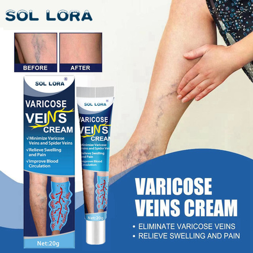 L Varicose Veins Cream Vein Ointment Nanovein Cream Against