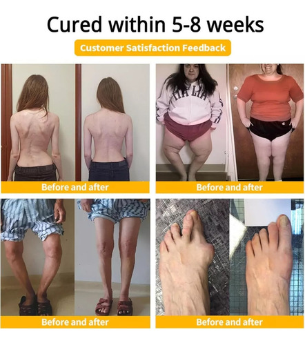 A Crema De Tratamiento De Artritis Con Cúrcuma Y De