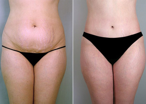 Imagen 2 de 4 de Tratamiento Lipolaser + Reductor + Radiofrecuencia 6+2 S Reg