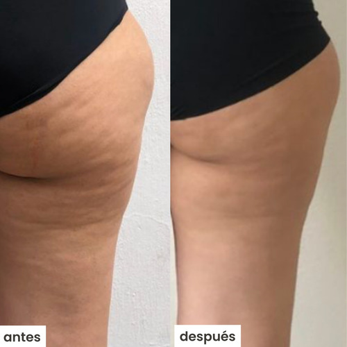 Kit Azala S/ Ventosa- Tratamiento Para Celulitis Cítrica