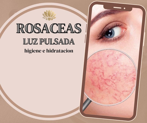 Rosaceas Con Luz Pulsada Intensa (caballito) (Usado)