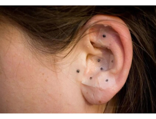 Ponto Auriculoterapia Cristal Auricular Micropore 350 Unid