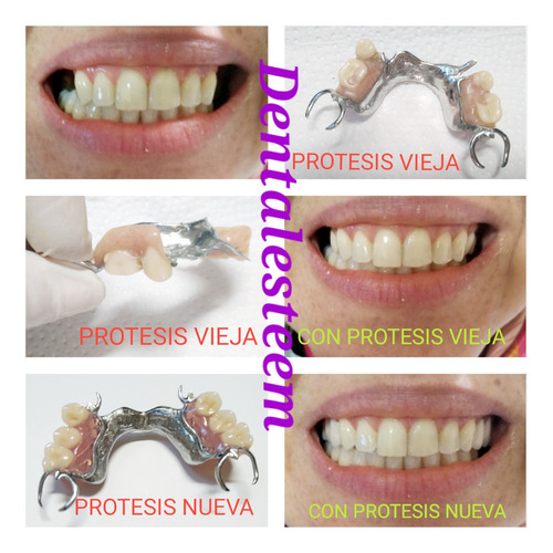 Imagen 2 de 5 de Prótesis Dentales Dentista Placas De Contencion Y Bruxismo