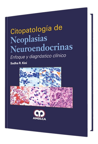 Citopatología De Neoplasias Neuroendocrinas. Edit. Amolca 