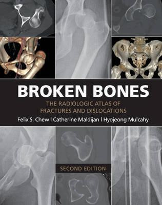 Libro Broken Bones - Felix S. Chew