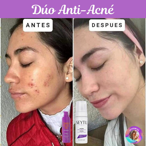 Dúo Anti Acne Cicatrices Manchas Piel Sensible Unisex