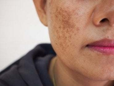 Imagen 2 de 2 de Acidos Peeling Quimicos Para Eliminacion De Manchas