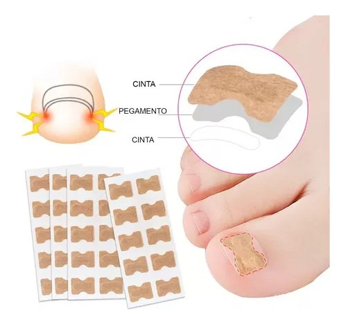 50 Parches Correctores Uñas Enterradas Uñeros Adhesivos