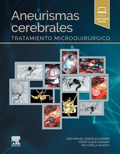 Aneurismas Cerebrales Tratamiento Microquirúrgico Gonzalez-d