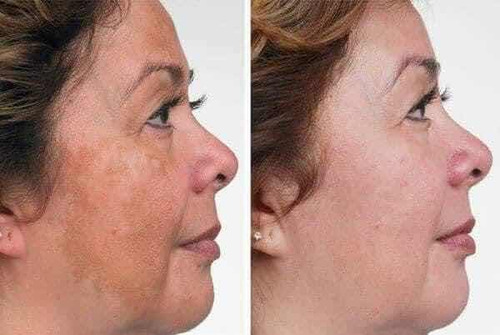 Quita Manchas Ácido Glicólico Hinode 30 Ml