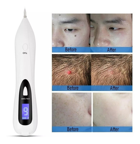 Imagen 2 de 7 de Plasma Pen Verrugas Manchas Pecas Cauterizacion Digital 2020