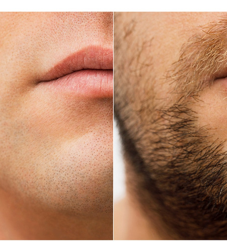 Minoxidil 2.5mg 30 Tabletas Mintop