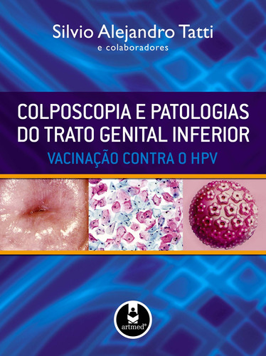 Colposcopia e Patologias do Trato Genital Inferior: Vacinação Contra o HPV, de Tatti, Silvio Alejandro. Artmed Editora Ltda., capa dura em português, 2010