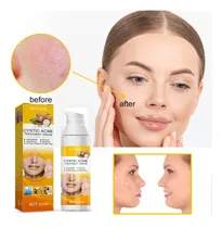 Comprar Creme De Tratamento De Acne T Cístico, Hormonal Grave Acne T