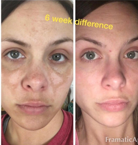Admire My Skin 2 % Hydroquinone Remove - mL a $5000