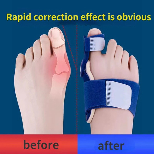 Corrector De Juanetes Hallux Valgus Ortesis, Férula