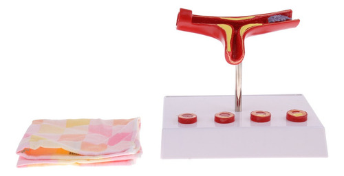 Modelo De Vascular De Trombo De Aterosclerosis De Vaso