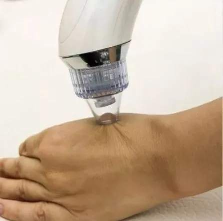Extractor De Espinillas Puntos Negro Elimina Acne Portátil