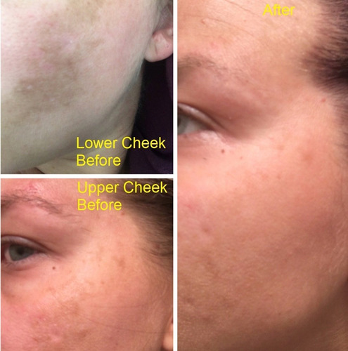Admire My Skin 2 % Hydroquinone Remove - mL a $5000