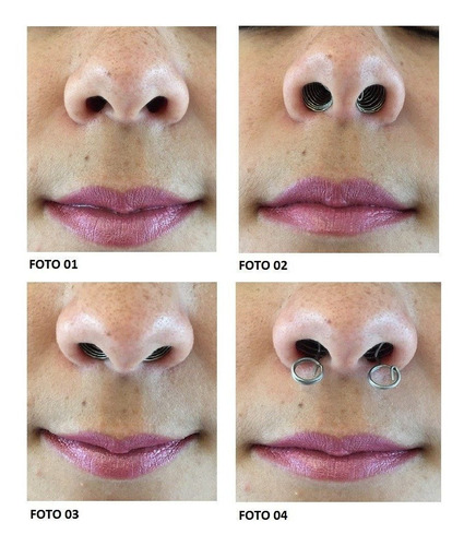 3 Pares Do Melhor Dilatador Nasal Do Mercado P, M Ou G