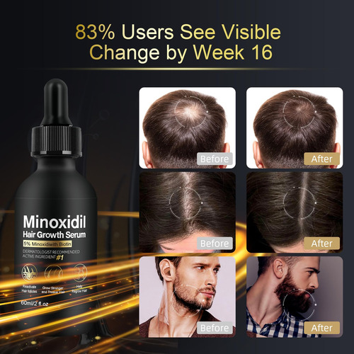 Sérum Para El Crecimiento Del Cabello Netyiyun Con 5% De Min