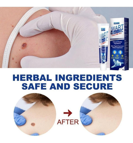 Cuidados De Limpeza Da Pele Para Remover Calos, Verrugas E V