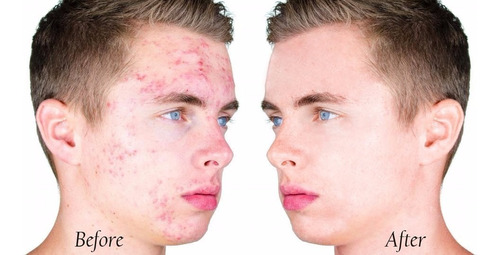 Crema Acido Salicilico Topico Rostro Facial Envio Gratis