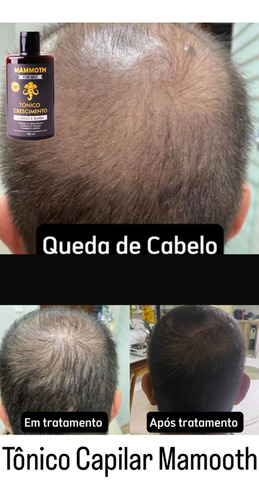 Kit Tônico Poderoso - Calvície - Alopecia - Queda/cabelo