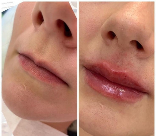 Imagen 2 de 5 de Aumento Y Perfilacion De Labios