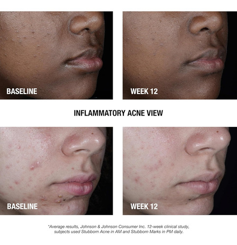 Tratamiento Facial Neutrogena Para El Acné Persistente Con P