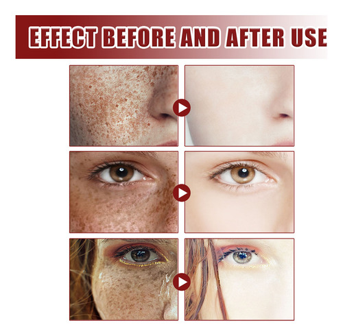 L Crema Antipecas Para Aclarar Las Manchas Y Melanina Para A