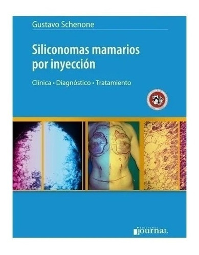 Siliconomas Mamarios Por Inyección Schenone Nuevo!