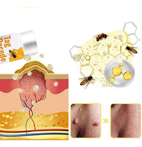 Crema Antipigmentaria Para Eliminar Las Verrugas Del Herpes,