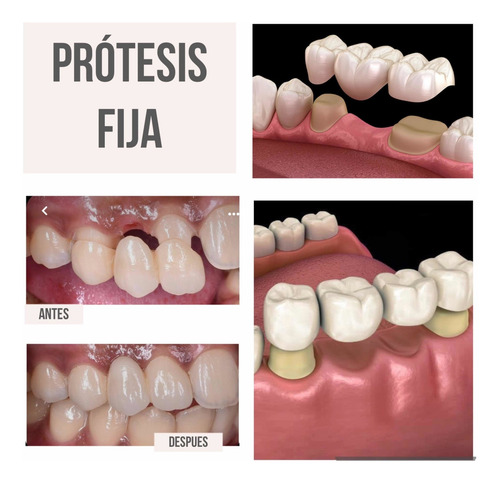 Imagen 3 de 5 de Prótesis Dental, Prótesis Fija