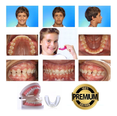 Ortodoncia Invisible Niños No Brackets Agnovedades
