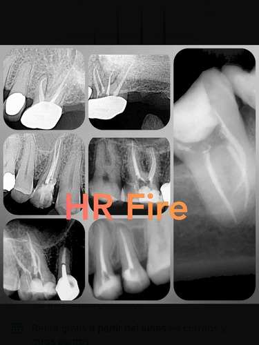 Limas Endodoncia Hr-fire By Easyinsmile. Sistema Completo