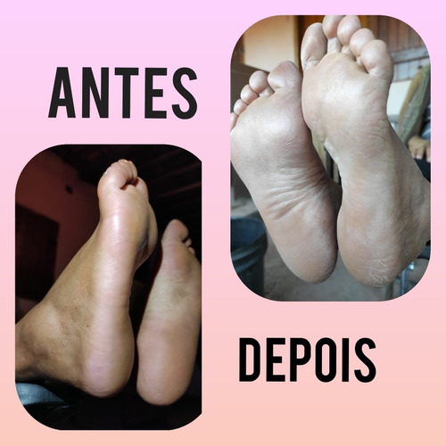 Imagem 1 de 1 de Plástica Dos Pés