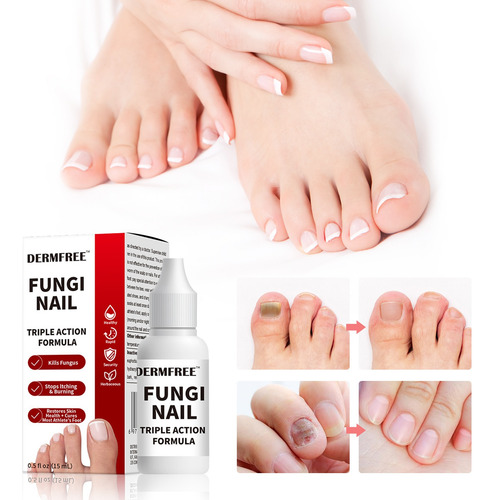 Hongo En Uñas Solución - Tratamiento De Uñas Grises 1pcs