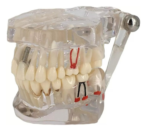 Modelo Estudio Explicativo Implantes Endodoncia Odontología