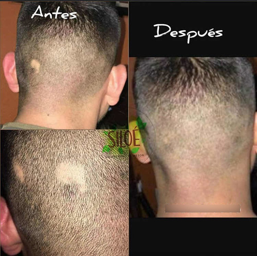 Adiós Calvicie, Alopecia, Psoriasis Pack 5 Shampoo Siloe