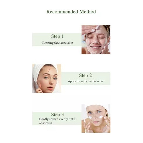Crema Facial Para Tratamiento Acne Joypretty 50g Oferta!