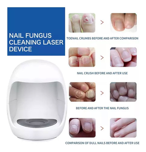 Tratamiento Láser De Hongos En Las Uñas Y Onicomicosis
