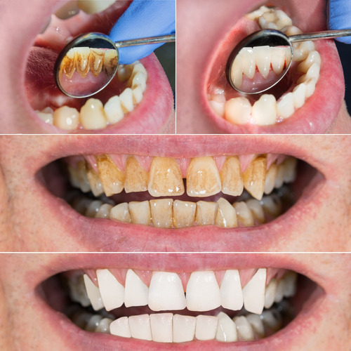 / Juego De Raspador Dental Para El - Unidad A $130806