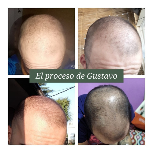 Imagen 9 de 10 de Tratamiento Para Crecimiento Del Cabello. Fértil
