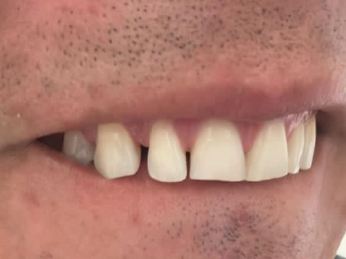 Corona Dental Zirconio