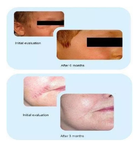 Elfleaf Dermatix Gel Tópico Reductor De Cicatrices Advanced Scar Reducer Silicone Super Gel 15 Gm